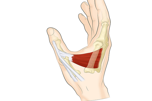 Entorse pouce skieur 